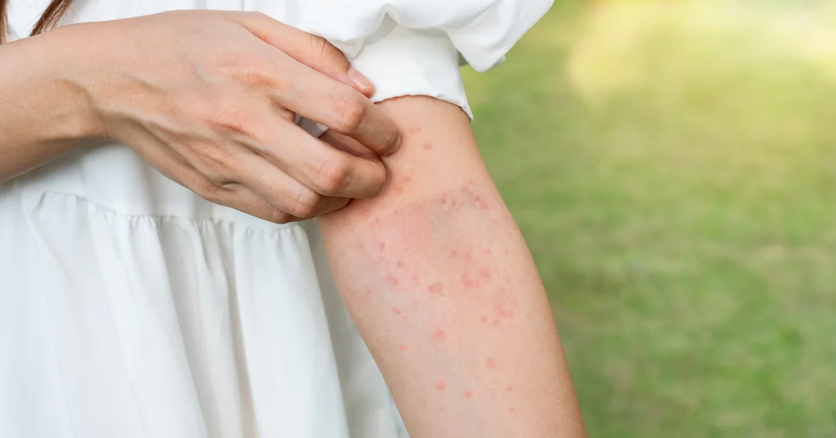 Understanding Insect Bites and Stings: Prevention and Treatment