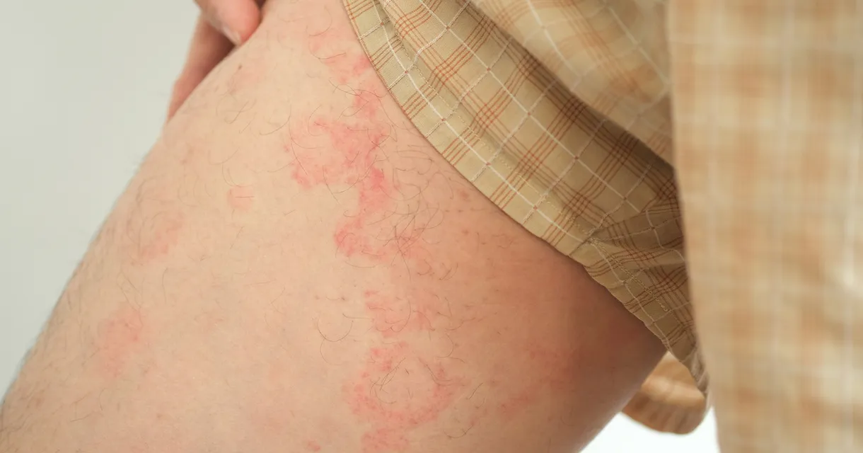 Your guide to incontinence associated dermatitis