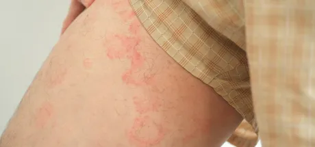 Your guide to incontinence associated dermatitis