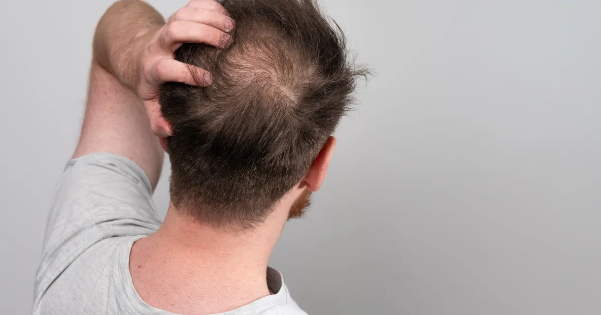 What Vitamin Deficiency May Cause Hair Loss?