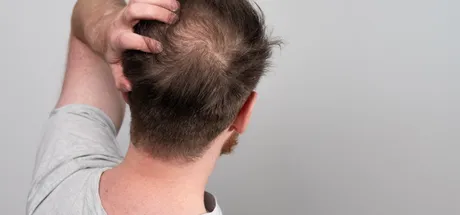 What Vitamin Deficiency May Cause Hair Loss?