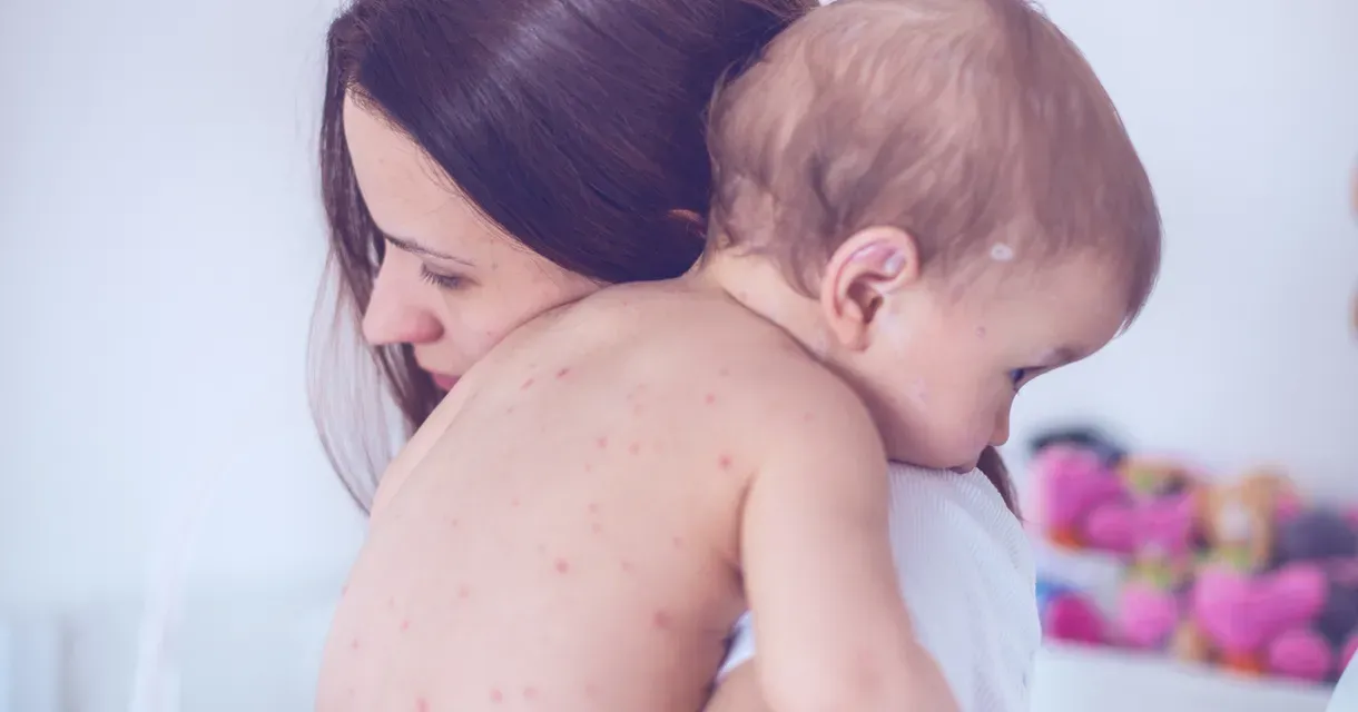 What Is Chickenpox: Causes, Symptoms, Stages & Treatments