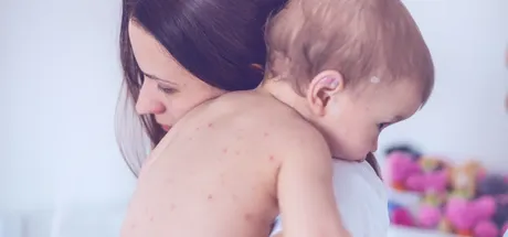 What Is Chickenpox: Causes, Symptoms, Stages & Treatments
