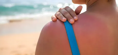 Sunburn Relief: What Works Fast for Red & Inflamed Skin