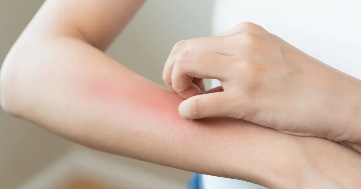 How to Stop an Insect Bite from Itching & Ways to Avoid Infection