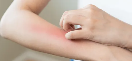 How to Stop an Insect Bite from Itching & Ways to Avoid Infection