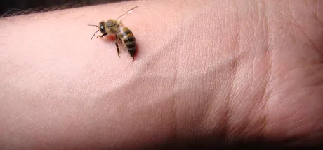 What Bug Bit Me? How to Identify Common Insect Bites