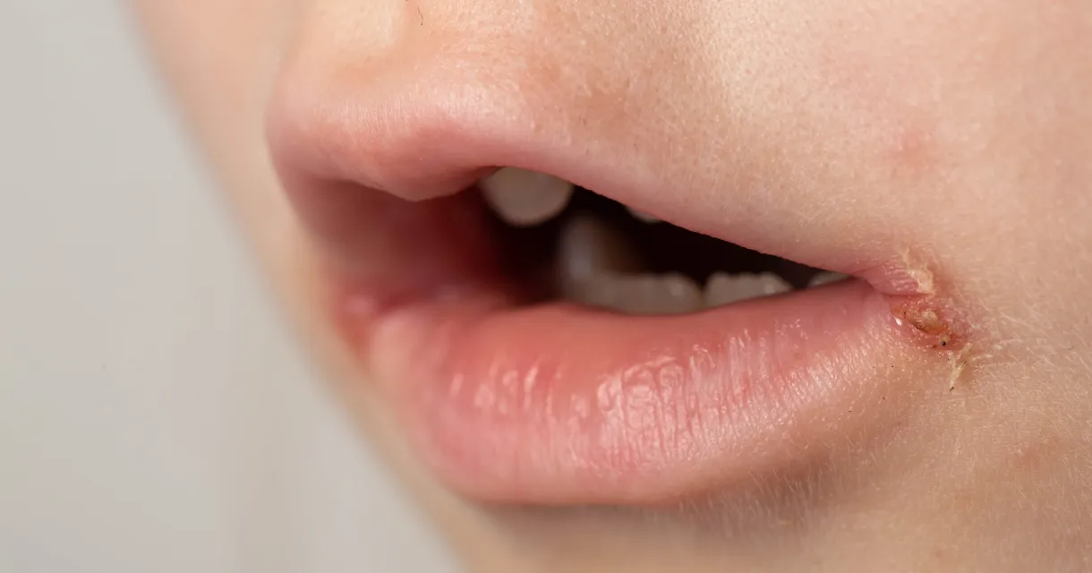What Is Impetigo? How It Spreads, Symptoms & Treatment