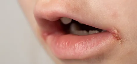 What Is Impetigo? How It Spreads, Symptoms & Treatment