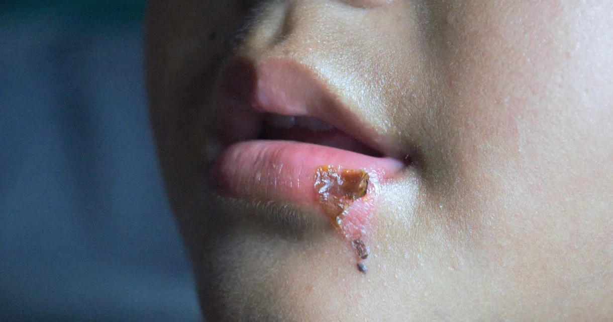 How to Stop Impetigo from Spreading: 7 Practical Tips