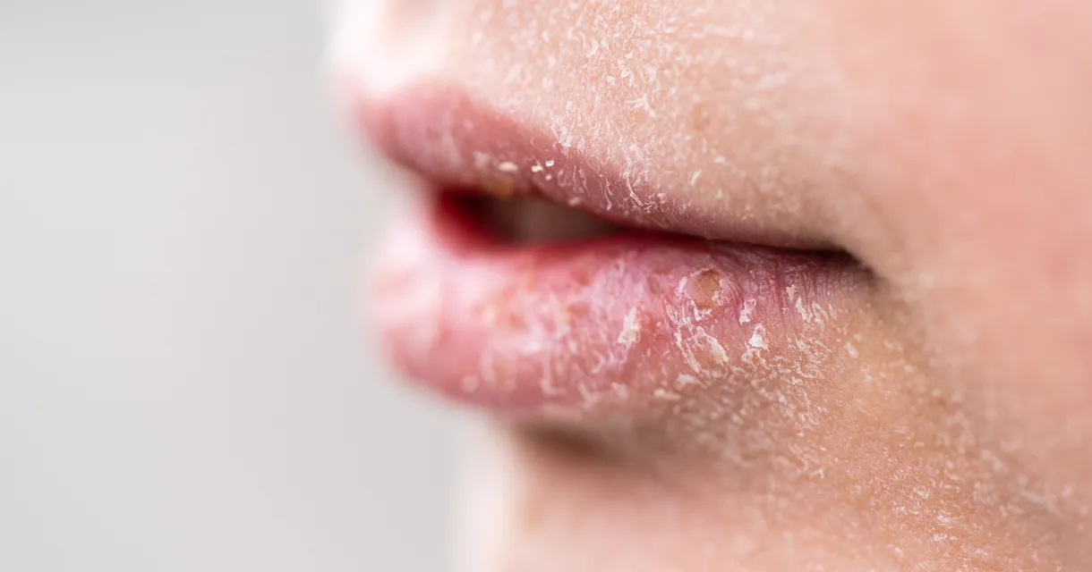 Impetigo vs Eczema vs Cold Sores: Key Differences & How to Tell Them Apart