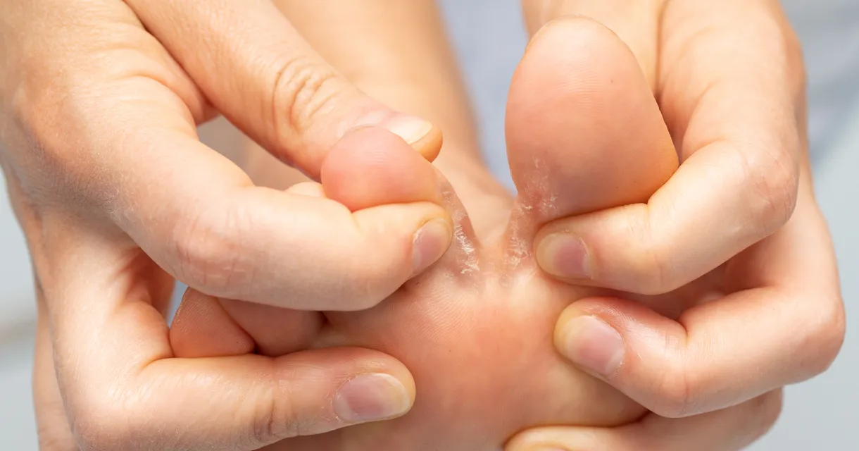 How to Care For Athlete’s Foot: Symptoms & Treatment