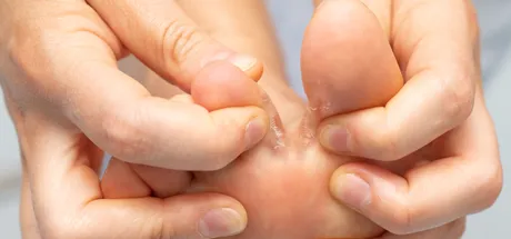 How to Care For Athlete’s Foot: Symptoms & Treatment