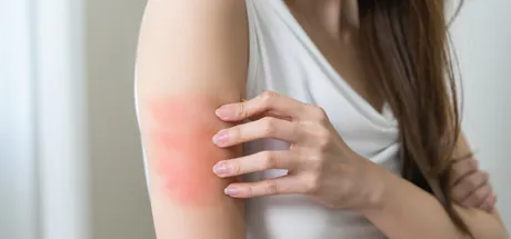 Why Does My Skin Break Out When I Travel? Common Triggers & Solutions