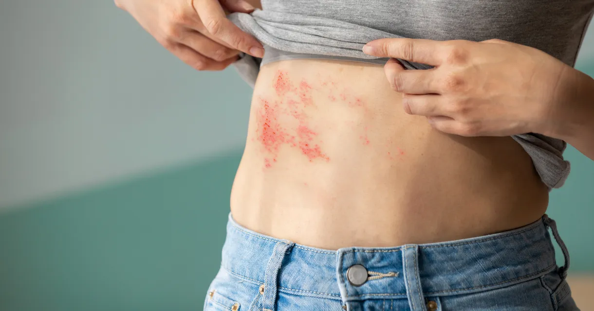 What Is Shingles (Herpes Zoster): Causes, Symptoms & Treatment