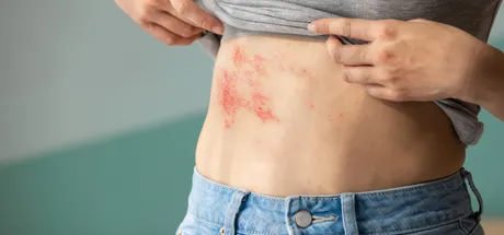 What Is Shingles (Herpes Zoster): Causes, Symptoms & Treatment