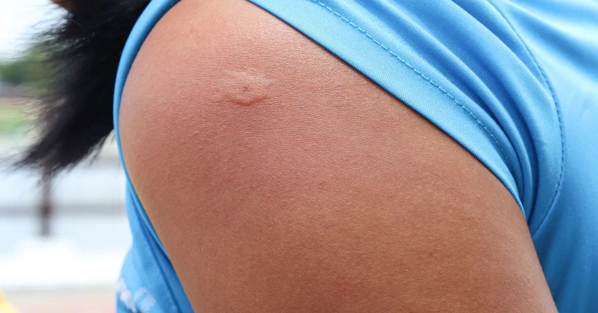 Insect Bite Emergency: When Should You Worry?