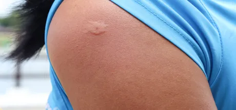Insect Bite Emergency: When Should You Worry?