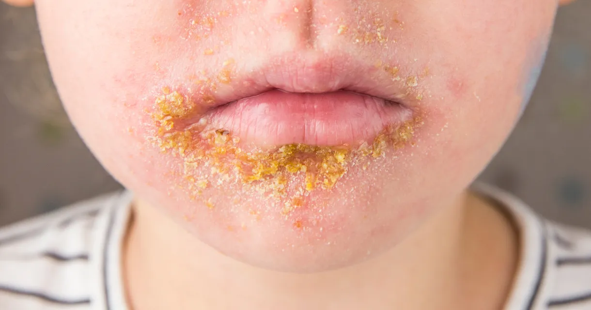Bullous vs Non-Bullous Impetigo: Key Differences Explained