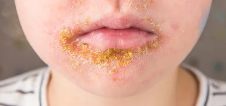 Bullous vs Non-Bullous Impetigo: Key Differences Explained