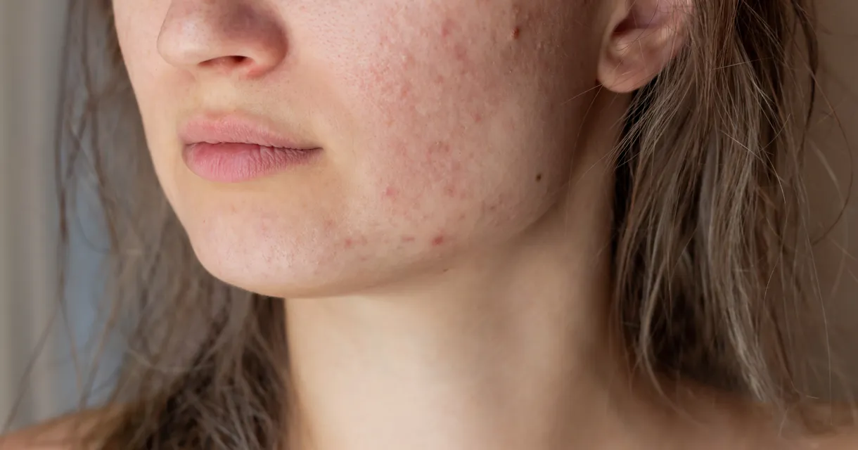 What’s the Best Spot Treatment for Acne?