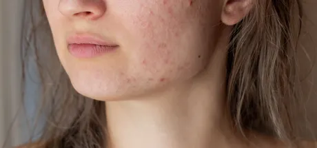 What’s the Best Spot Treatment for Acne?