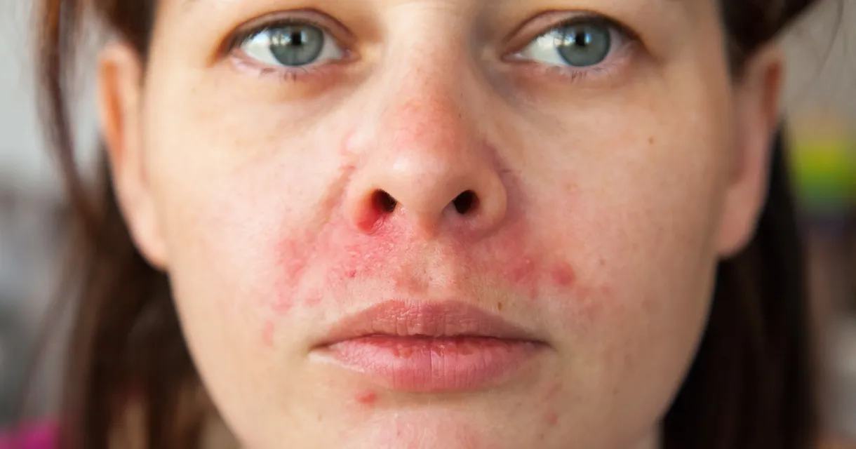 How To Get Rid of Perioral Dermatitis Overnight: An Expert Guide