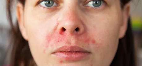 How To Get Rid of Perioral Dermatitis Overnight: An Expert Guide