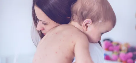 Chicken Pox: Causes and Prevention