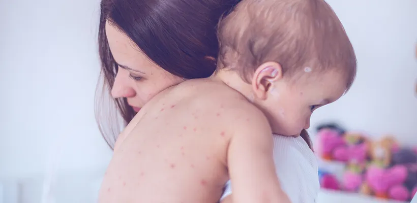 How Can You Catch Chicken Pox?