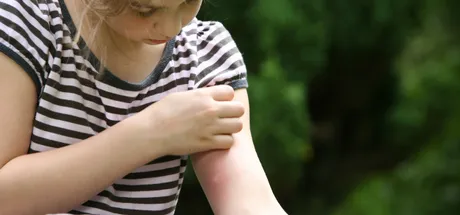 Bee and Wasp Stings – Children