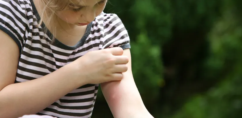 Bee and Wasp Stings – Children