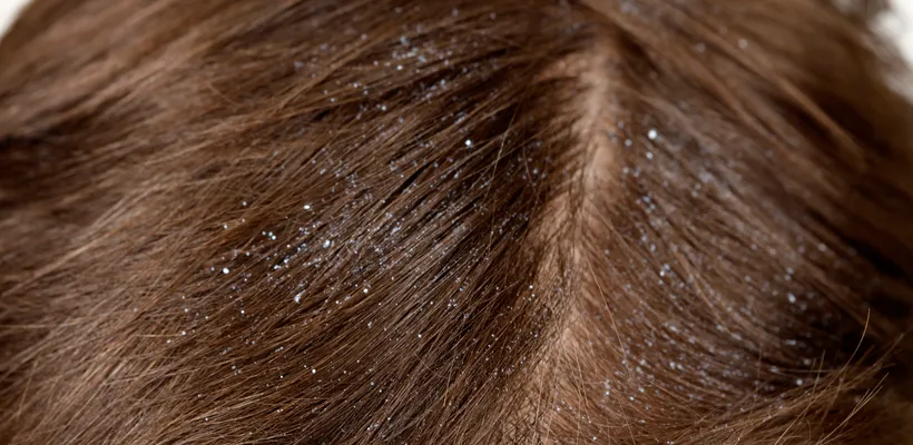 Dandruff Causes and Treatment