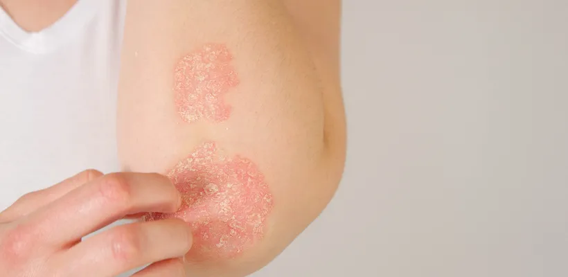 Psoriasis: Symptoms, Treatments and Causes