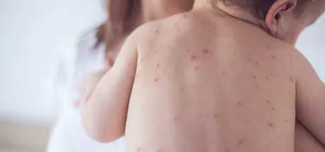 Symptoms & Stages of Chickenpox: a Guide for Adults & Children