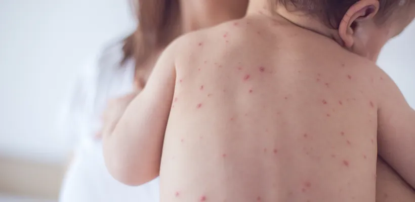 Symptoms & Stages of Chickenpox: a Guide for Adults & Children