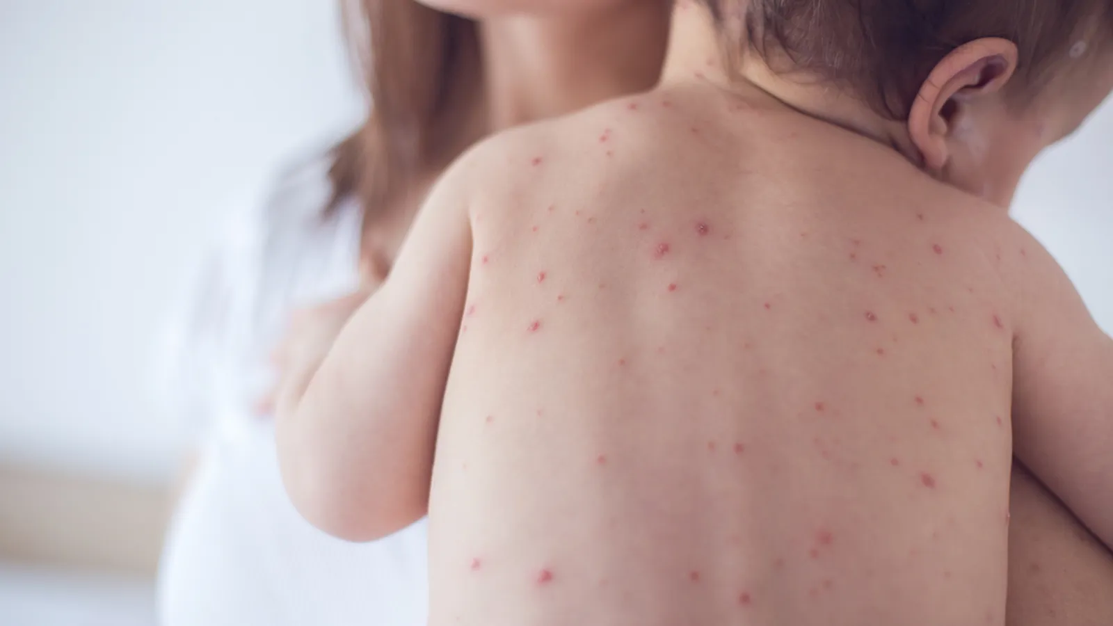 Chicken pox on sale in kids