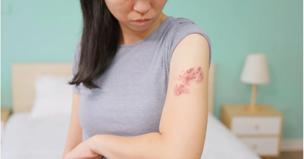 Shingles Treatment and Advice Service
