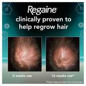 Picture showing the top of two heads on 14 weeks after treatment showing improvement